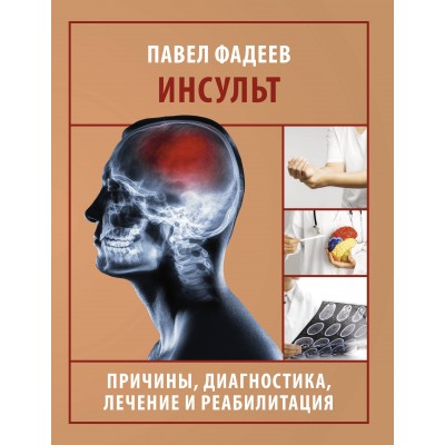 Инсульт. Причины, диагностика, лечение и реабилитация. Фадеев П.А.